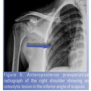 Isolated Tubercular Osteomyelitis of Scapula – A Report of Two Cases and Review of Literature Isolated Tubercular Osteomyelitis of Scapula – A Report of Two Cases and Review of Literature