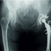 Yersinia enterocolitica Arthritis after Total Hip Arthroplasty – A Case Report Yersinia enterocolitica Arthritis after Total Hip Arthroplasty – A Case Report