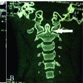 Cruciate Paralysis in a 20- year -old Male with an Undisplaced Type III Odontoid Fracture Cruciate Paralysis in a 20- year -old Male with an Undisplaced Type III Odontoid Fracture