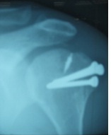 Osteotomy and Re-fixation for treatment of Malunited Greater Tuberosity of Humerus. Case 5 – Jan -Mar 2012. Journal of Orthopaedic Case Reports