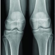 patellar instability