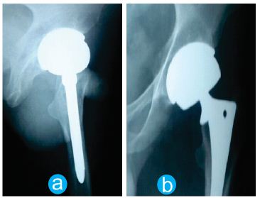 Figure 3: Radiograph of hip joints at three years after surgery.  