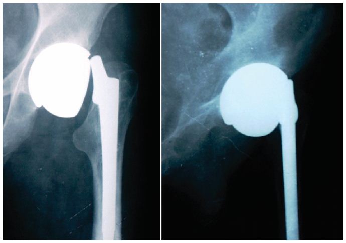 Figure 4: Anterioposterior  and Lateral radiograph of hip joints at five years after surgery. The       modular femoral head disassembled from the stem and remained in the acetabular socket 