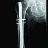 Temporary Fixation Using A Long Femoral Tibial Nail To Treat