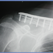 Progressive Brachial Plexus Palsy after Osteosynthesis of an Inveterate Clavicular Fracture