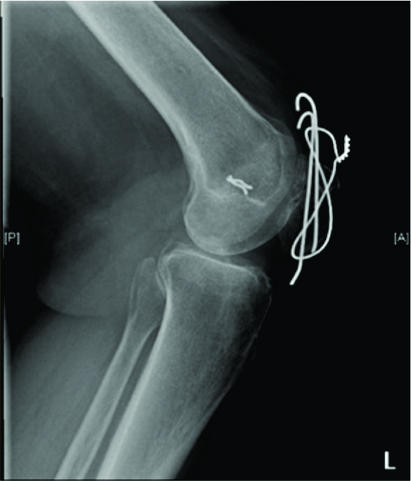 rt patella