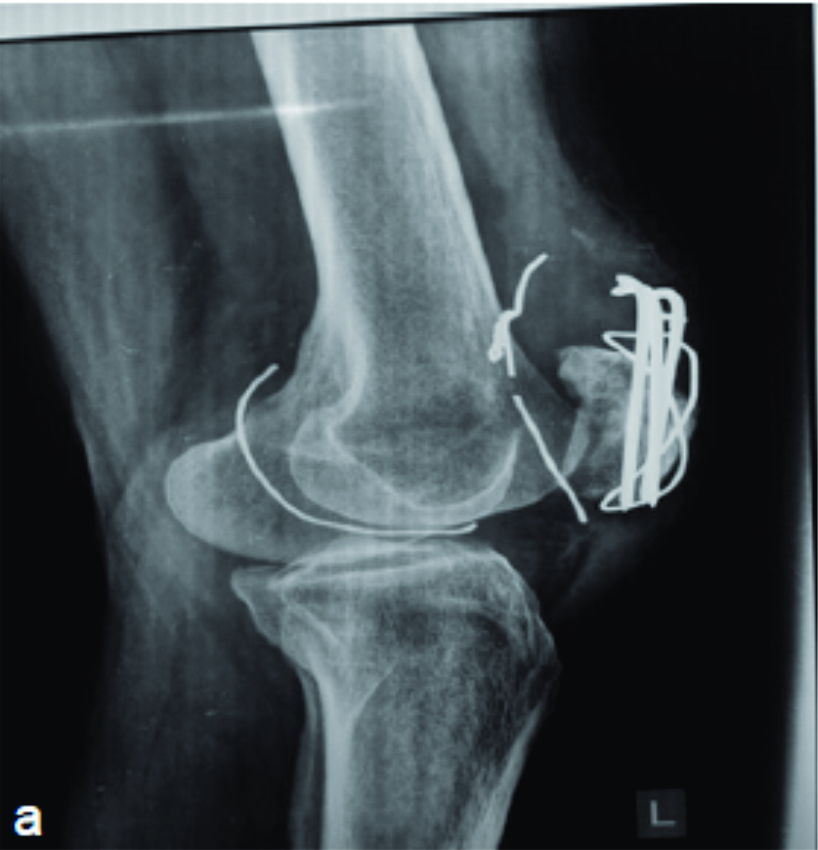 treatment for broken patella
