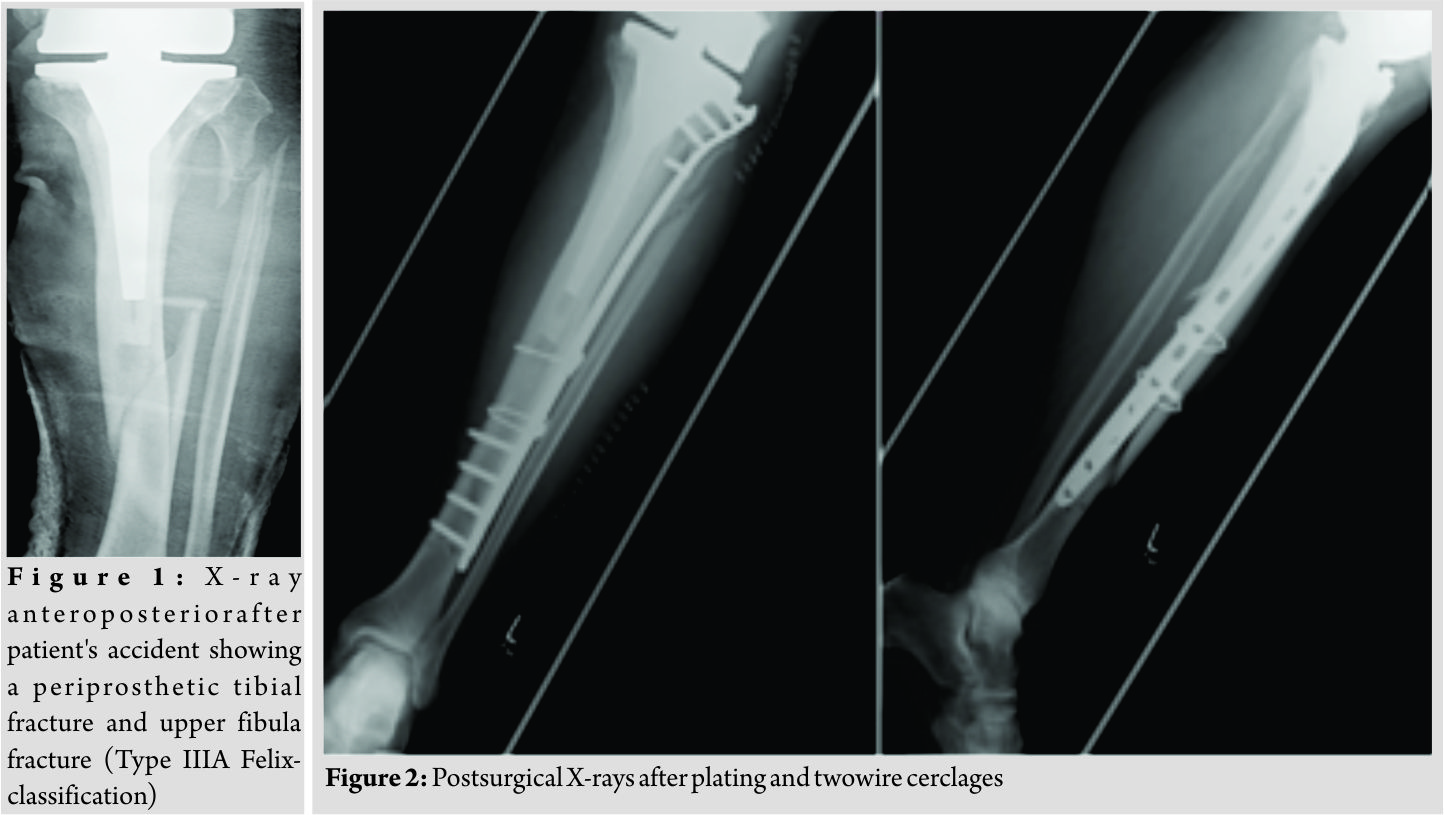 Xray Film Of A Patient Leg Showing Repaired Fractured Proximal Tibia. The  Orthopedic Plate And Nails Fixation Was Done. Stock Photo, Picture and  Royalty Free Image. Image 123966939.