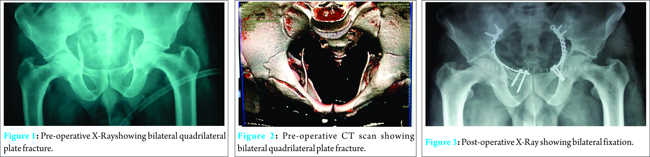 Fig 1 2 3