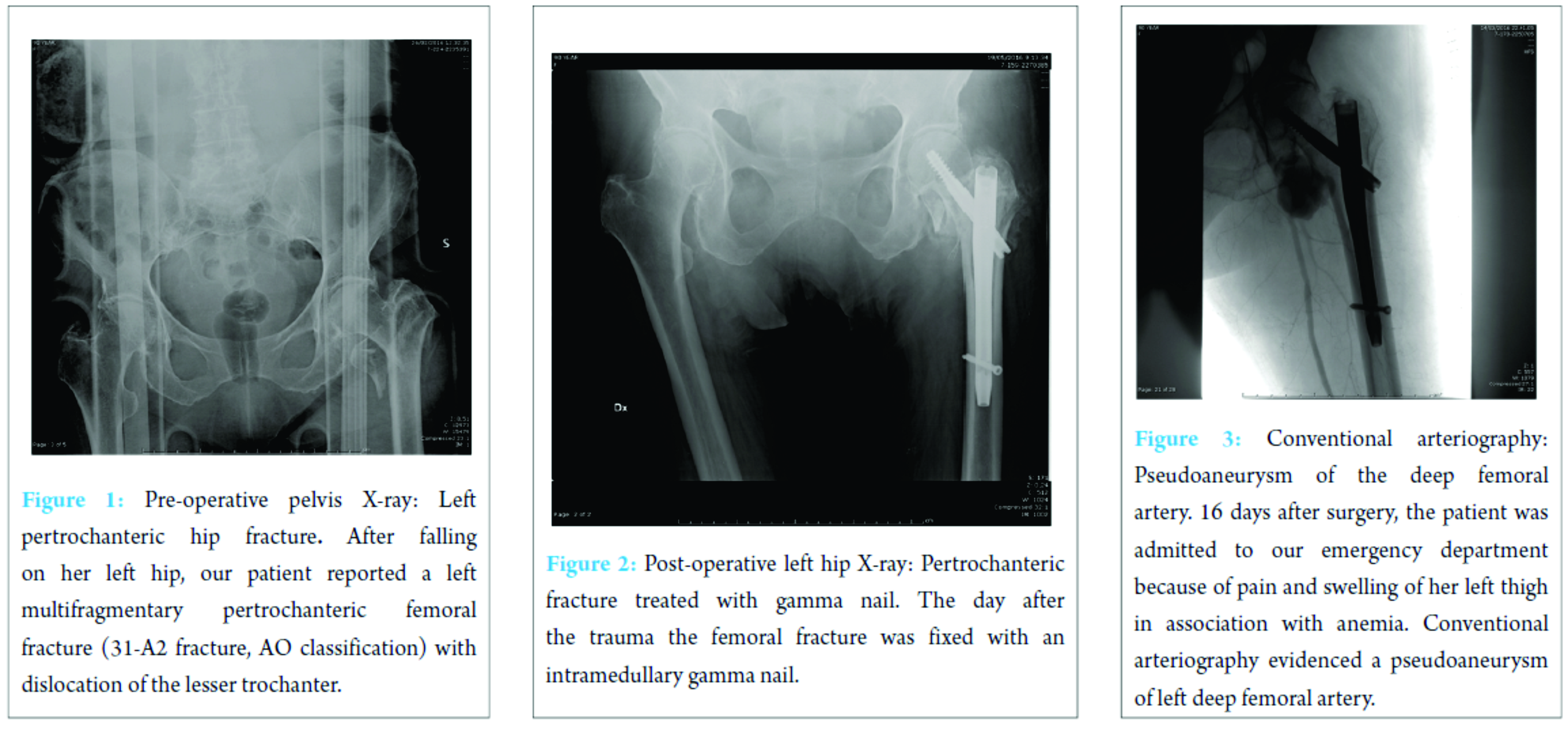 Hip fracture - Wikipedia