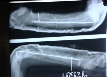 Figure 2: Postoperative X-Ray showing excision of distal ulna and fibular strut grafting stabilized with k wire