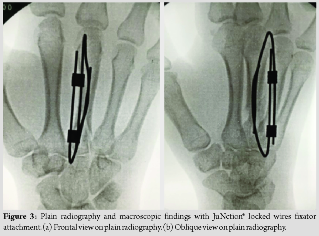 5th Metacarpal Shaft Fracture Clinical Practice Guidelines