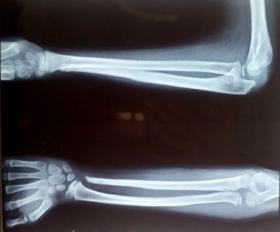 Figure 3: Post operative X Ray at 1 year follow up showing good uptake of fibular graft with no recurrence of lesion