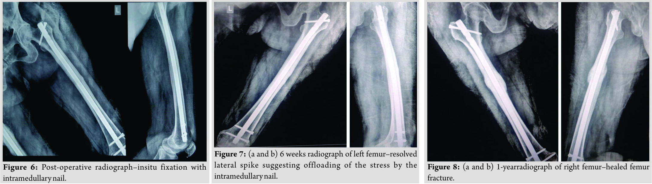 Femoral Shaft Fractures - Trauma - Orthobullets