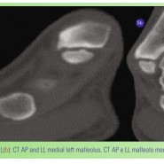 Congenital Pseudoarthrosis of Medial Malleolus in A Young Soccer Player – Diagnosis in Clinical setting of Ankle Sprain